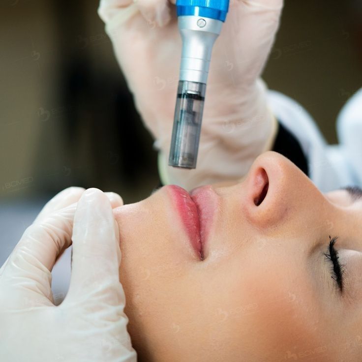 Microneedling