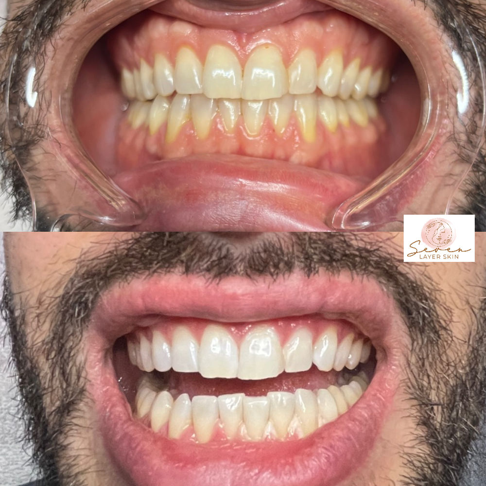 Teeth Whitening