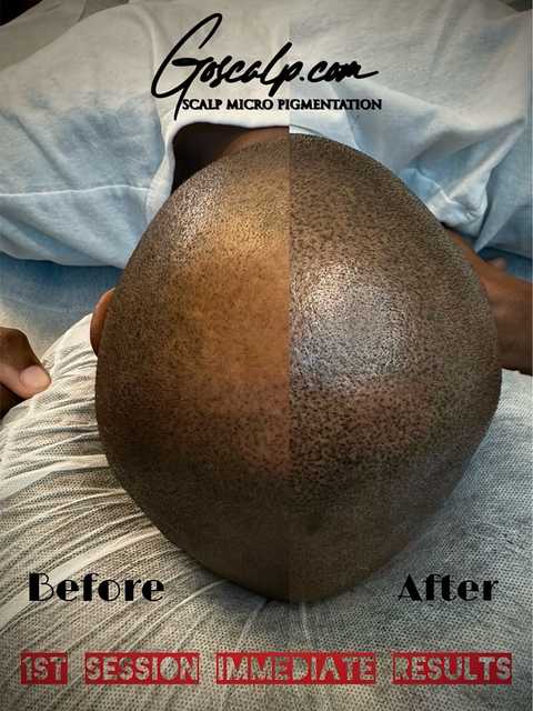 SMP Crown Density Fill