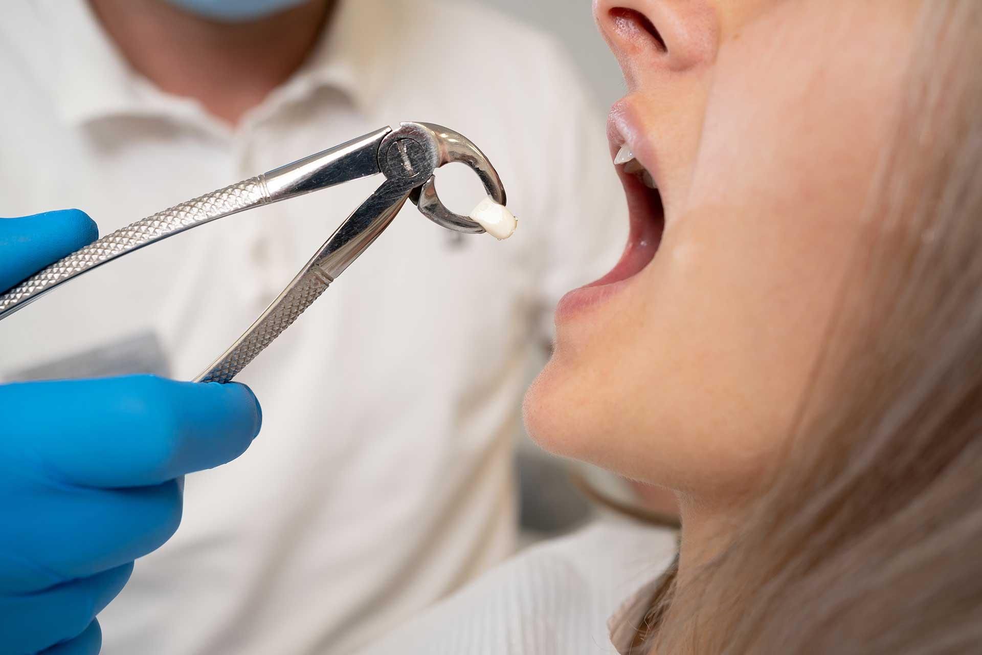  dental,procedure,tooth extraction,dentist,patient,tool 