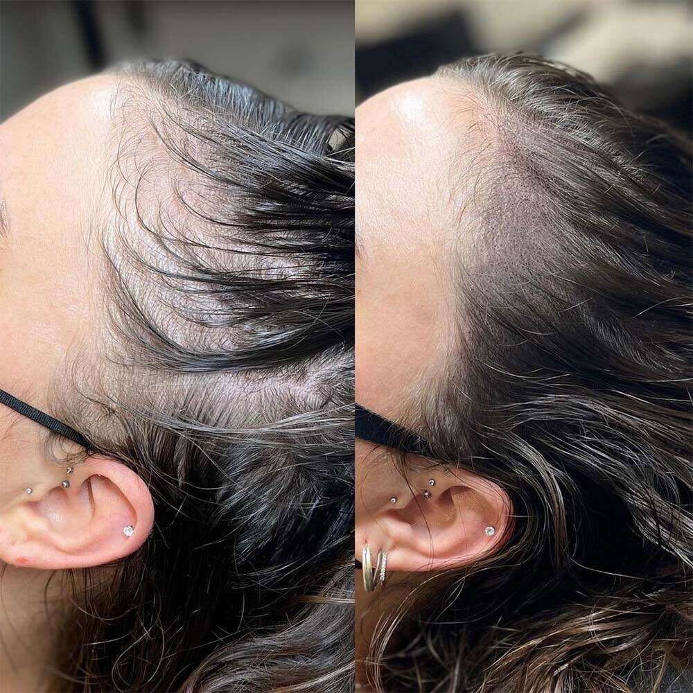 Scalp Micropigmentation (SMP)