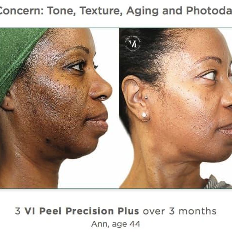 Chemical Peels