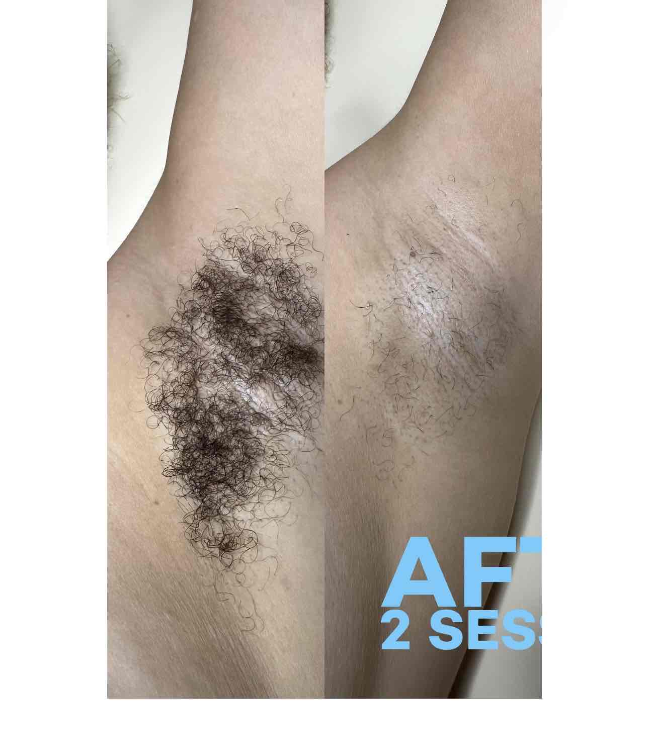  hair-removal,comparison,skin-care,before-and-after,laser-treatment 