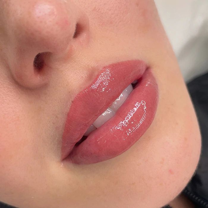 Lip Fillers