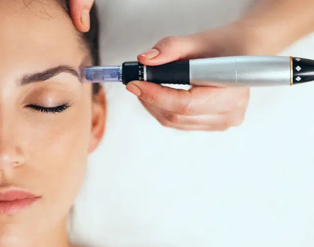 Microneedling