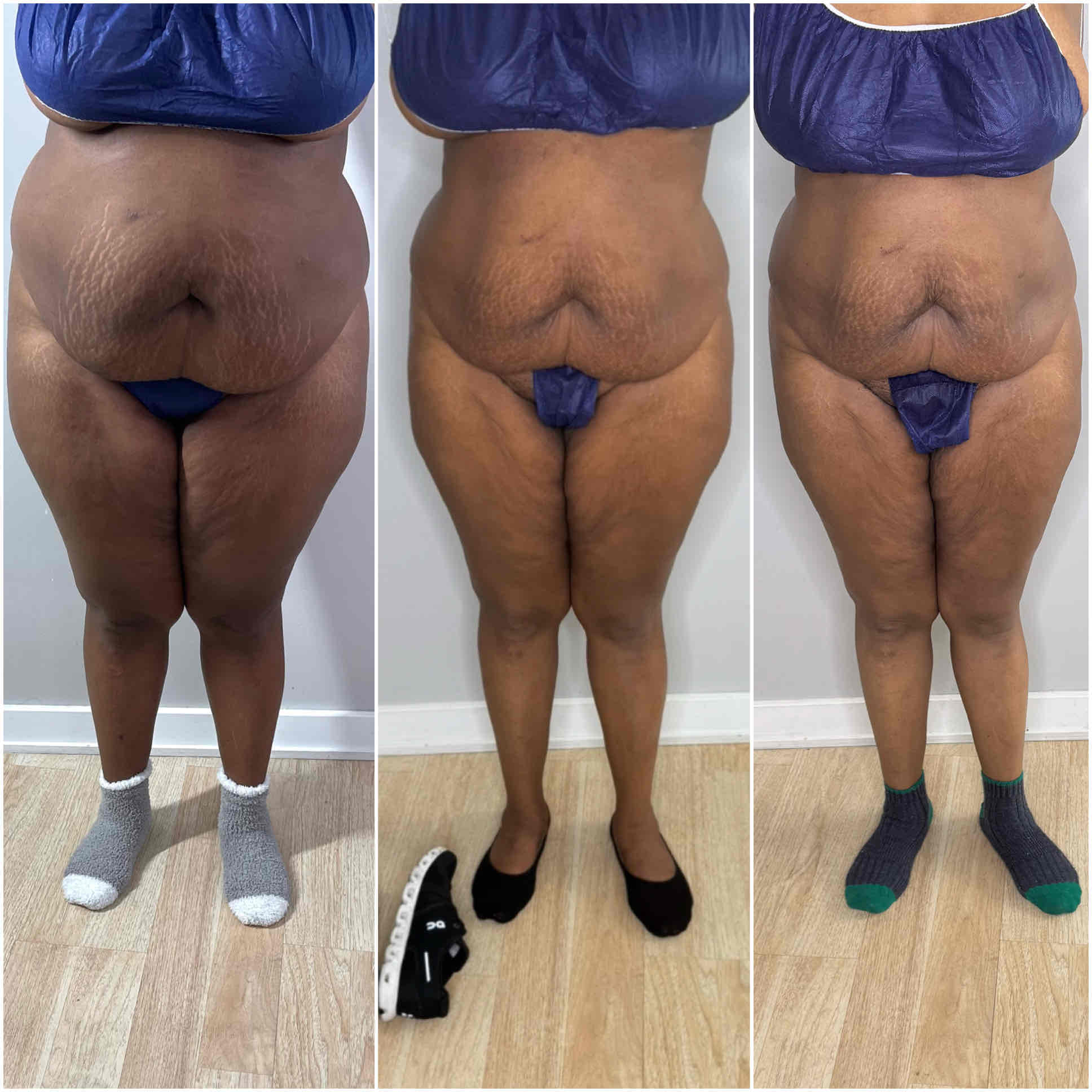  before and after,transformation,weight loss,comparison  