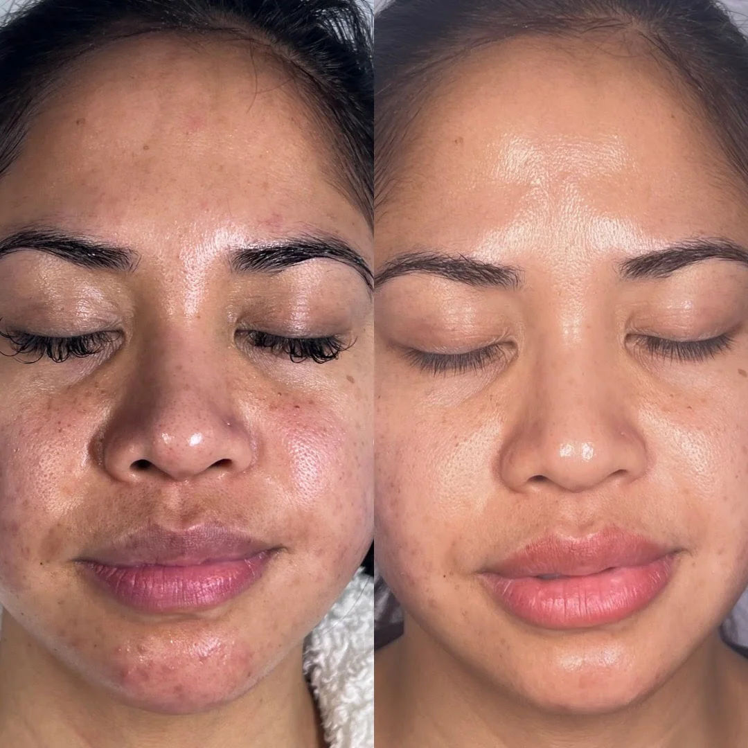  before-and-after,facial,skincare,treatment,results  