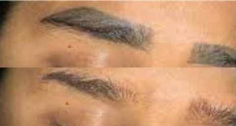 Laser Eyebrow Micro Blading Removal