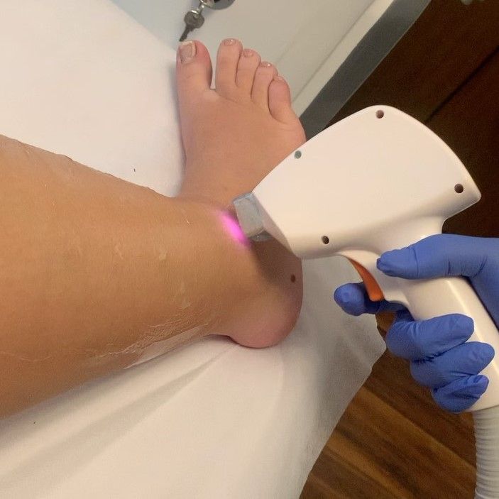 Laser Hair Removal