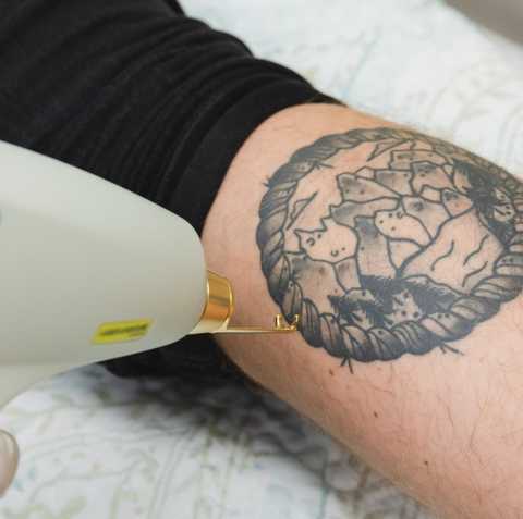 Laser Tattoo Removal & Fading service