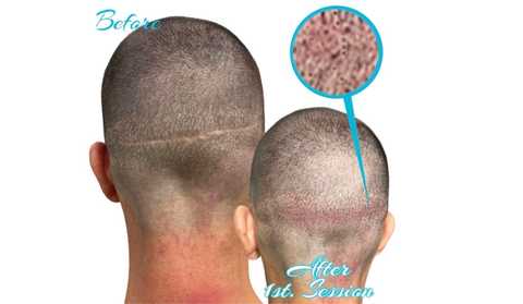 FUE Scar Camouflage