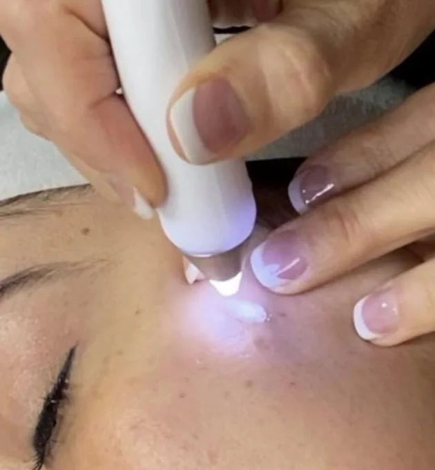 Spot Removal Treatments