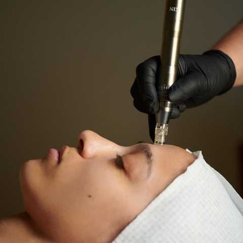 Microneedling service