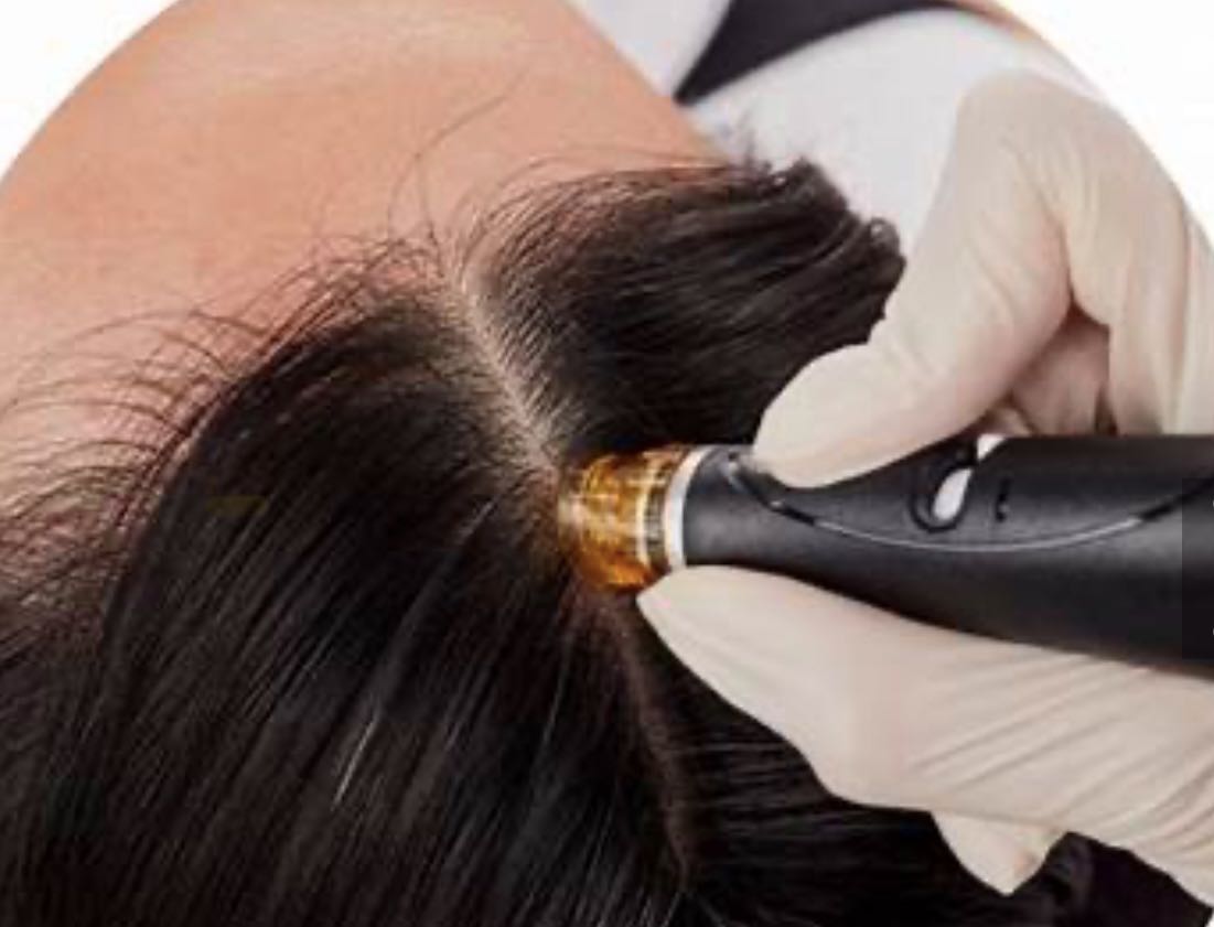Keravive Scalp Treatment