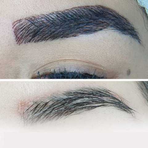 Permanent makeup/Tattoo Removal service