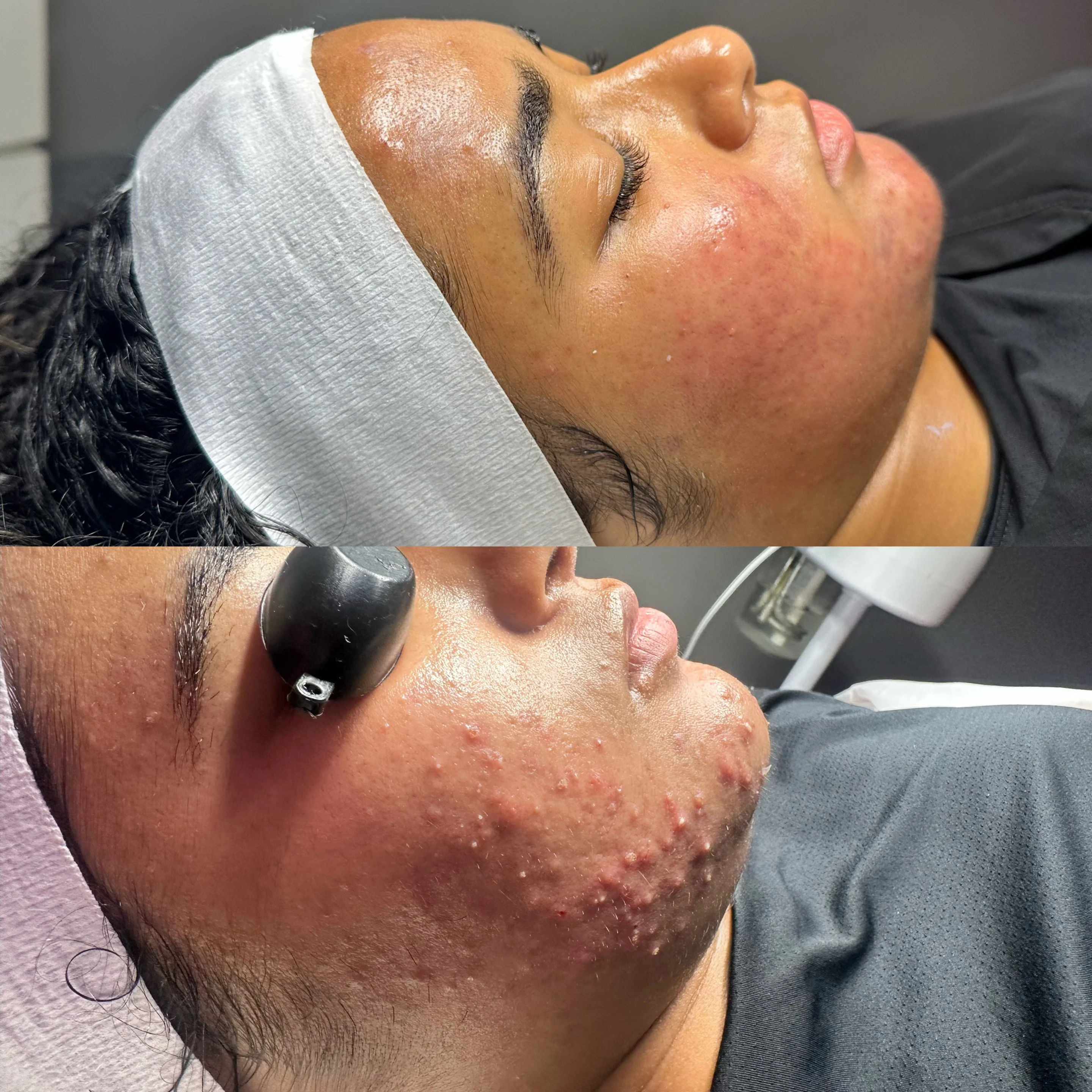 before and after,skin treatment,facial spa,skincare
