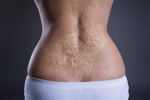 Healed Skin Burn Cover up’s