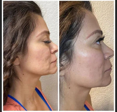  cosmetic-procedure,before-after,facial-treatment,profile-view 