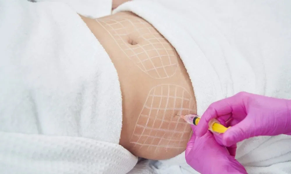 Intra Lipo Therapy