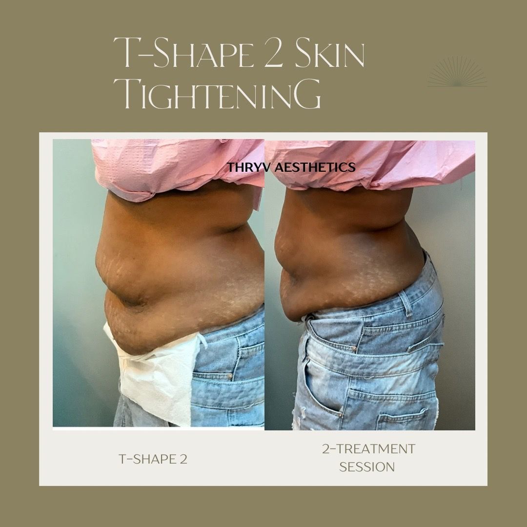  skin-tightening,body-contouring,beauty 