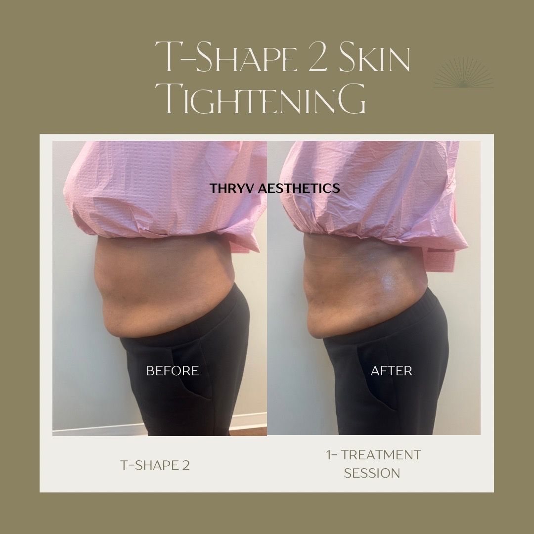  skin-tightening,cosmetic-procedure,beauty-treatment 