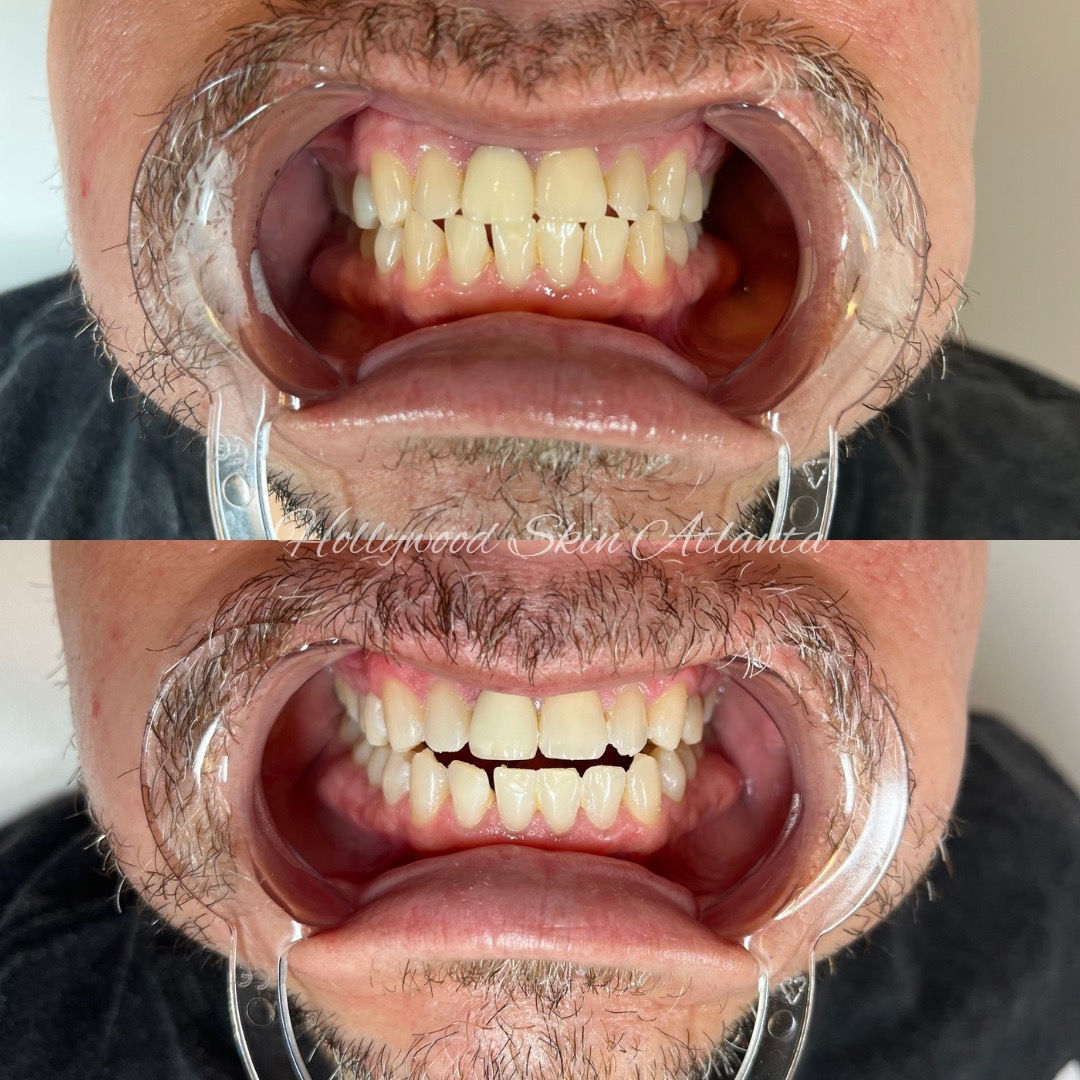  dental,teeth,before-after,health  