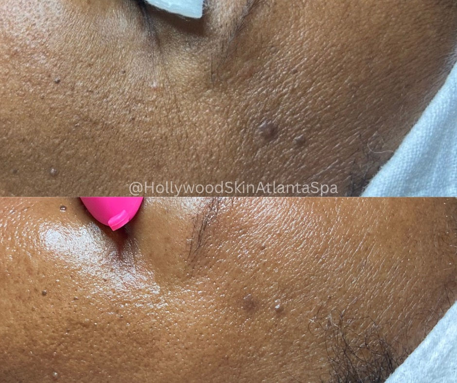  before-and-after,skin-care,treatment,beauty  