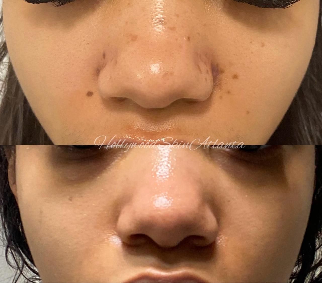  before-after,skin-treatment,facial-care,beauty 