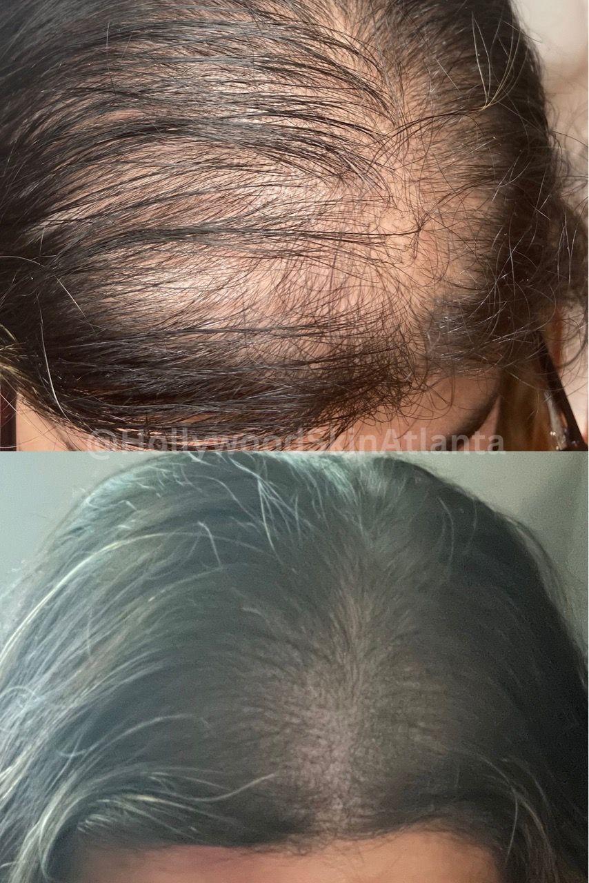  hair,scalp,before-after,comparison,hair restoration  