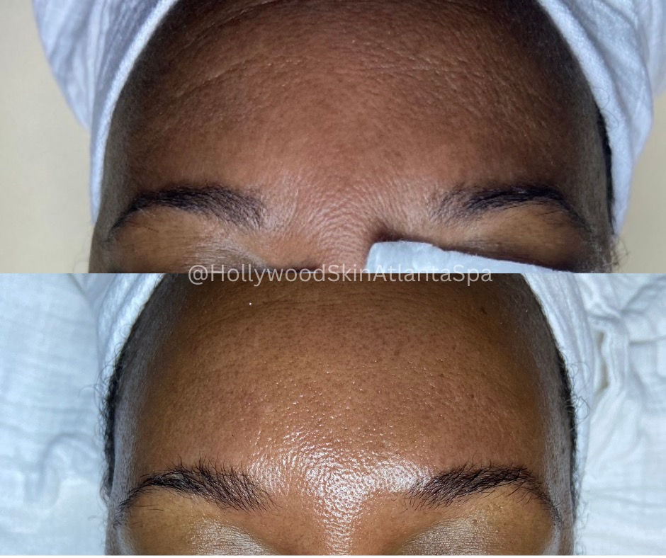  skincare,forehead,before-after,comparison,watermark  