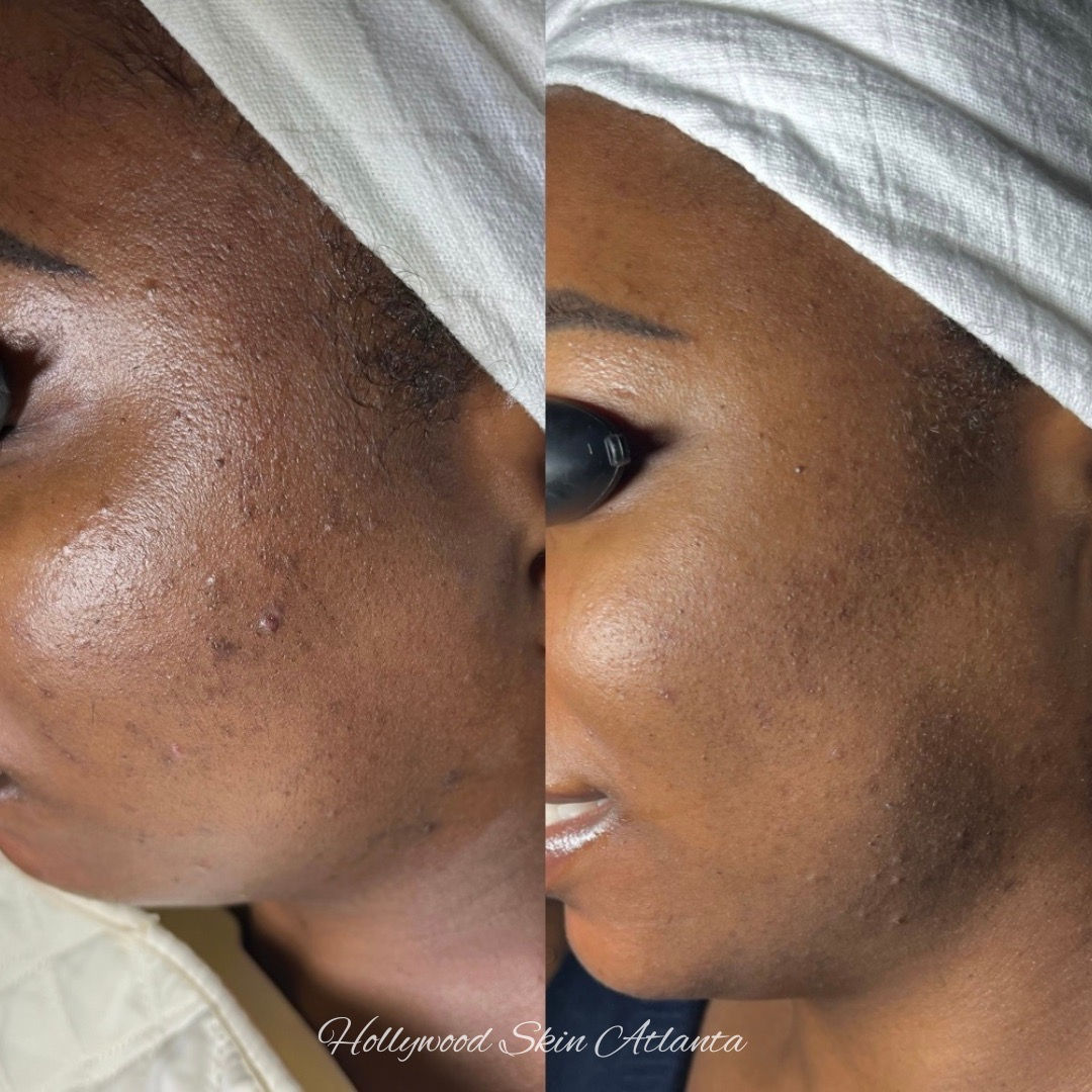  before-and-after,skincare,facial-treatment,skin-texture 