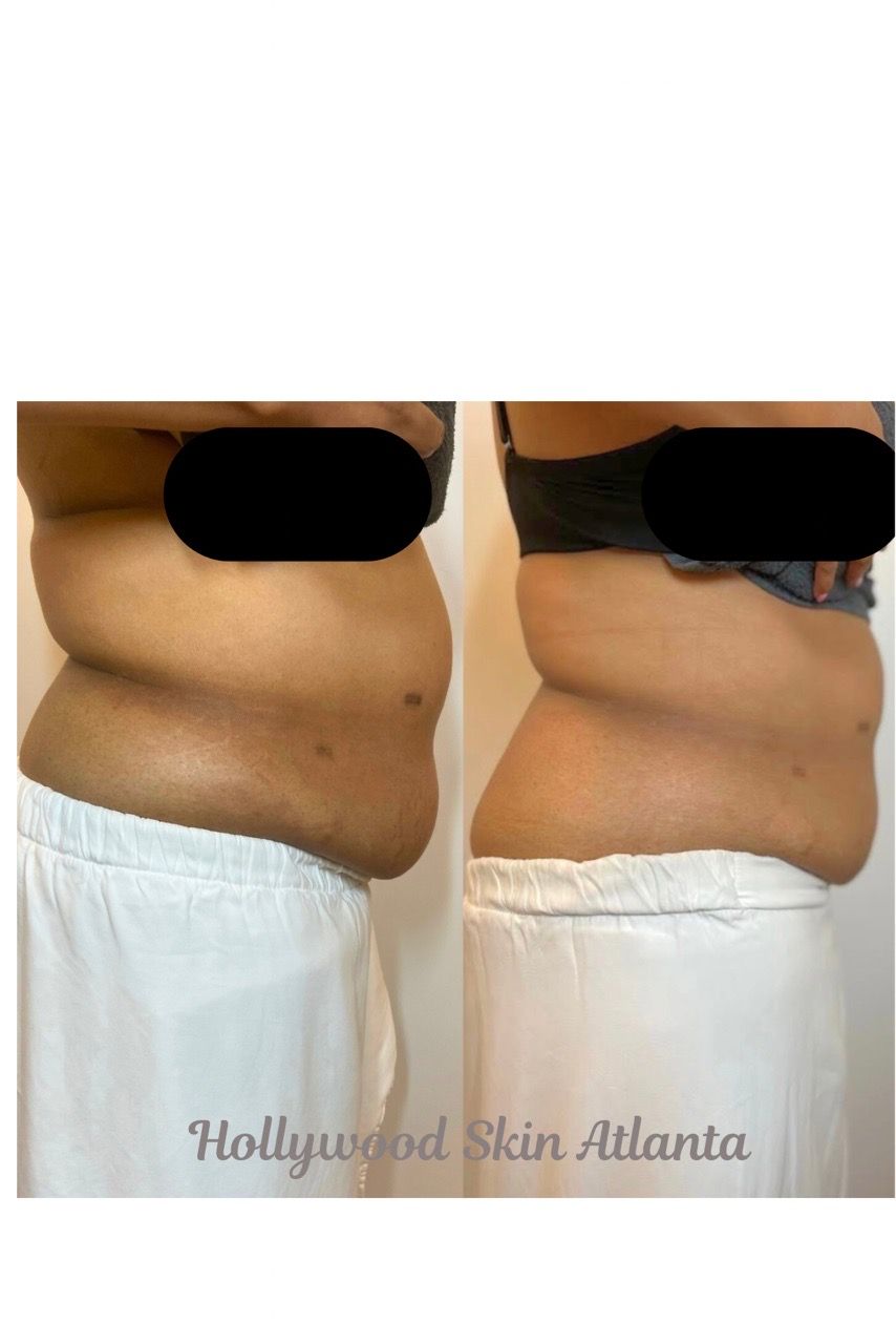  before-after,cosmetic,skin-treatment,body-contouring  