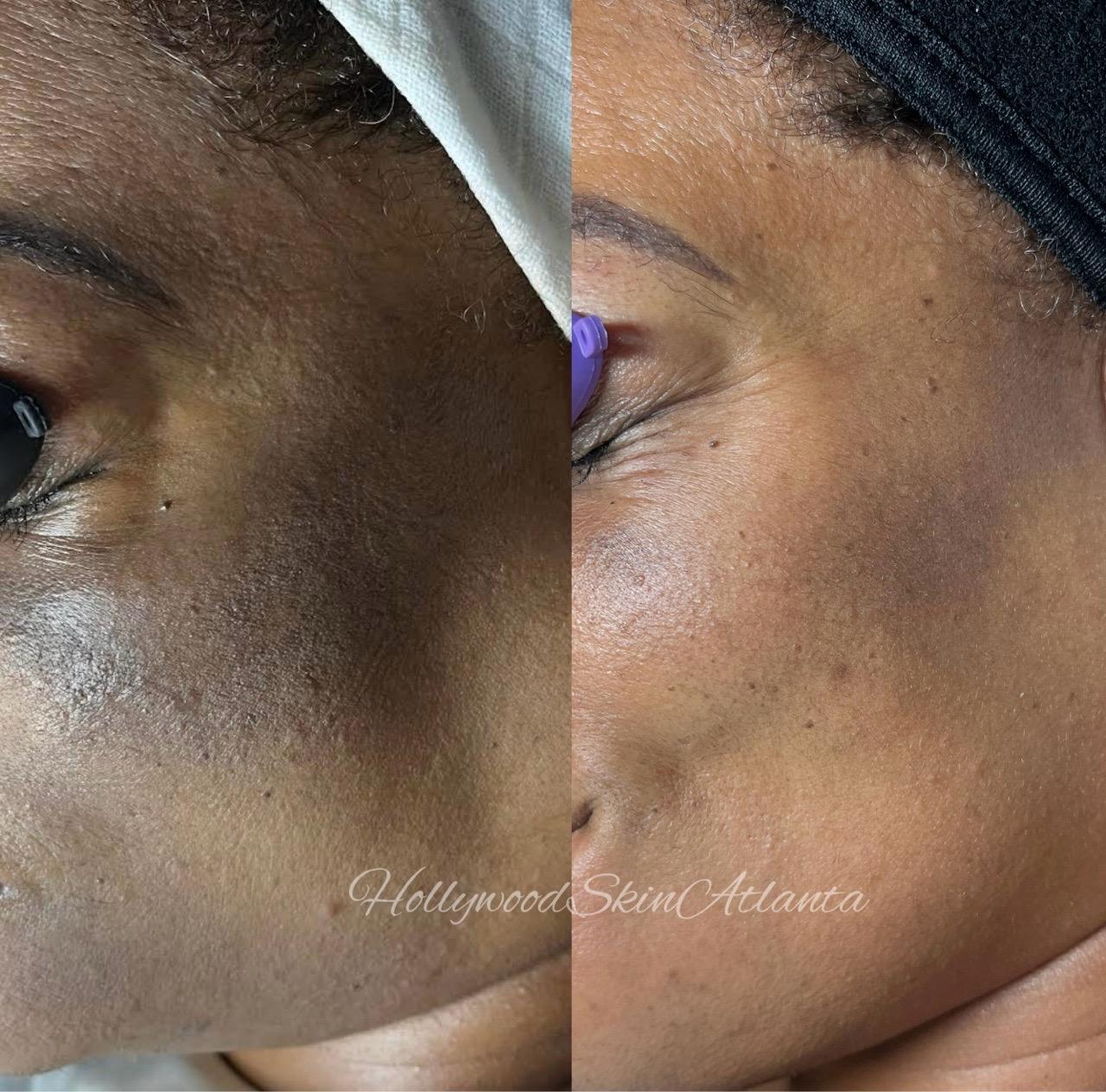  skin-treatment,before-after,skincare,transformation  