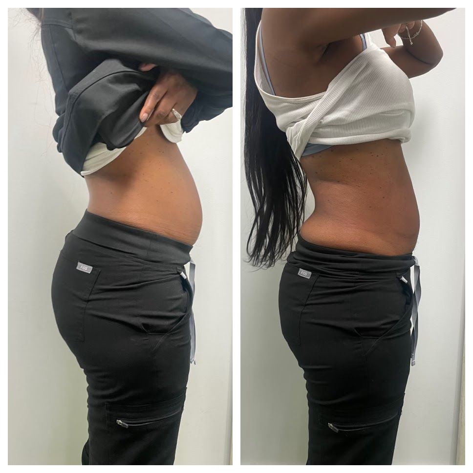  before-and-after,body-contouring,fitness-results,side-view  