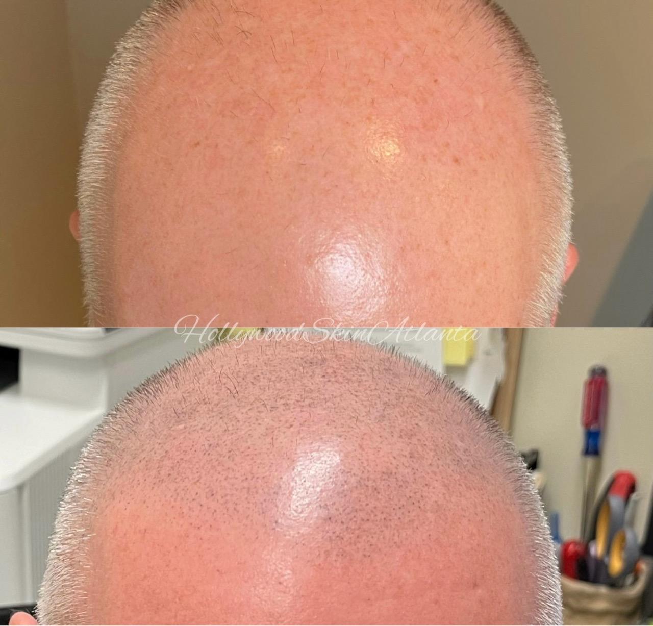  scalp,transformation,before and after,hair treatment  