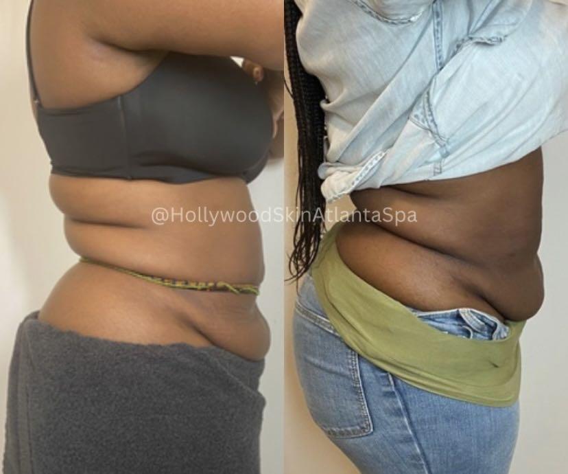  before-and-after,body-transformation,medspa,service-result  