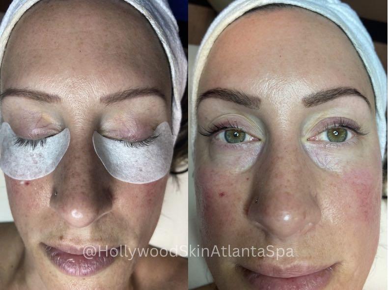  before and after,facial treatment,beauty service  