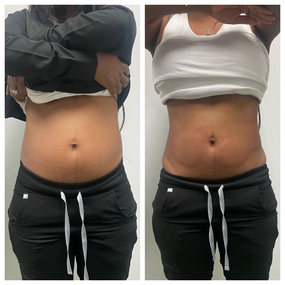  before-and-after,body-transformation,midsection  