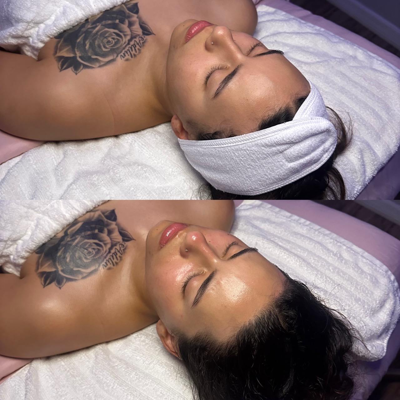  before-after,skin care,facial treatment,spa 