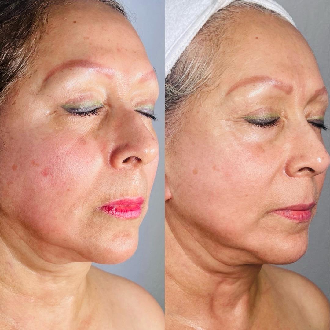  facial,skincare,before-and-after,beauty,medspa  