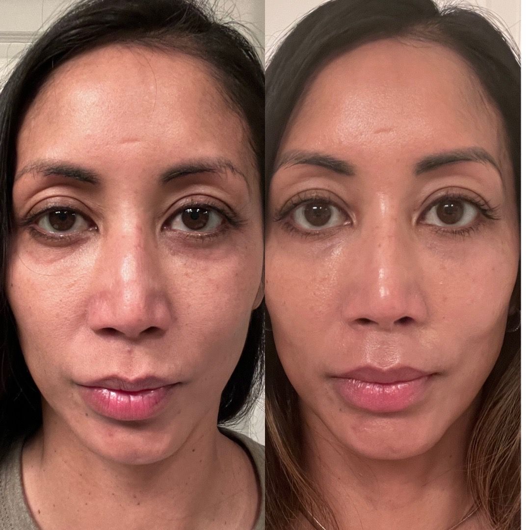  before-after,skincare,facial,complexion,beauty-treatment  