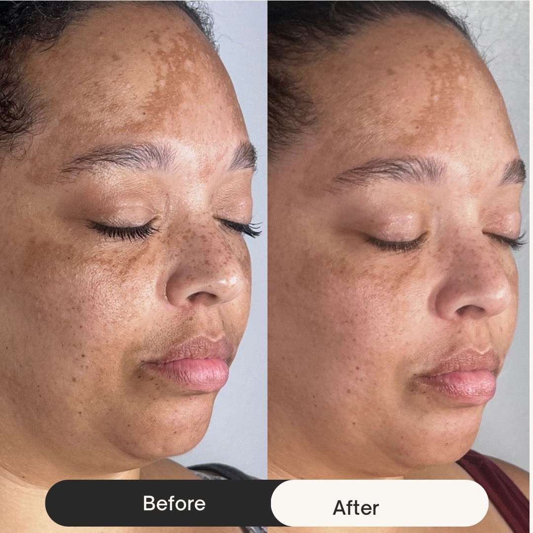  before-after,skin-care,comparison,facial-treatment  