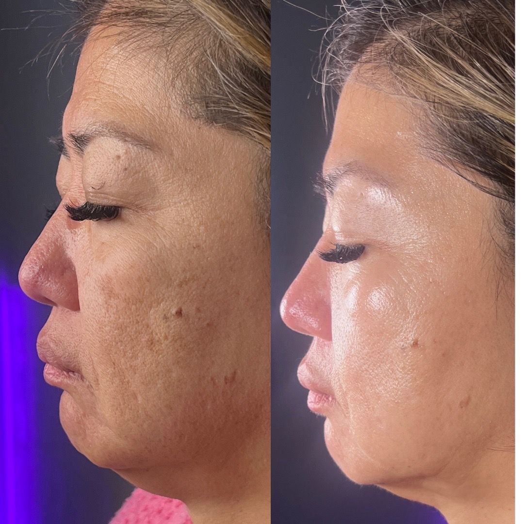  before-after,skincare,facial,beauty,comparison  