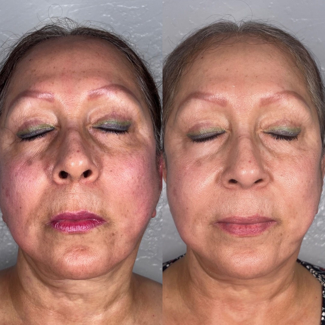  before-and-after,beauty,skincare,comparison  