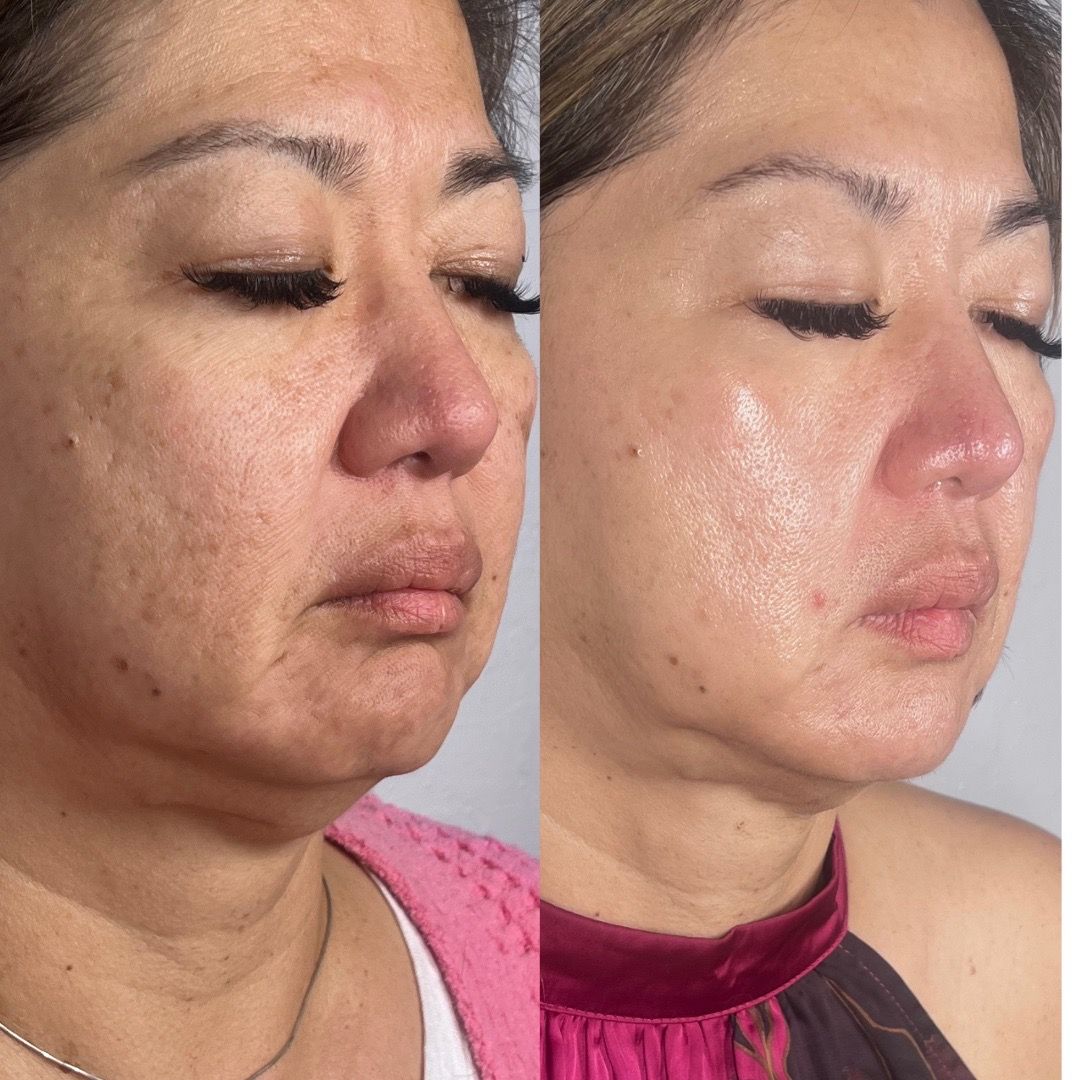  before-after,skincare,treatment,facial  