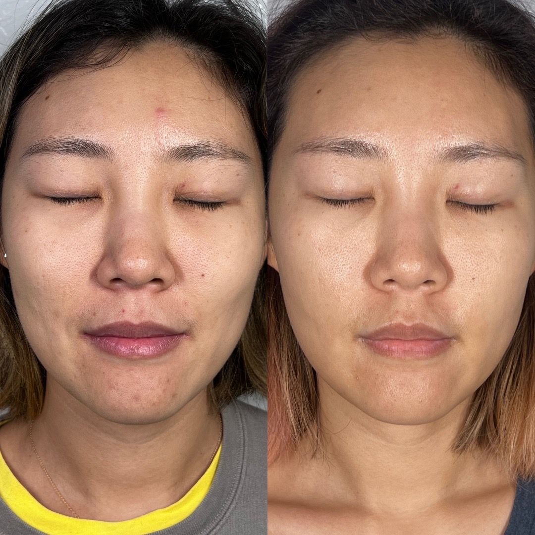  before-and-after,facial,skin-care,cosmetic-treatment  